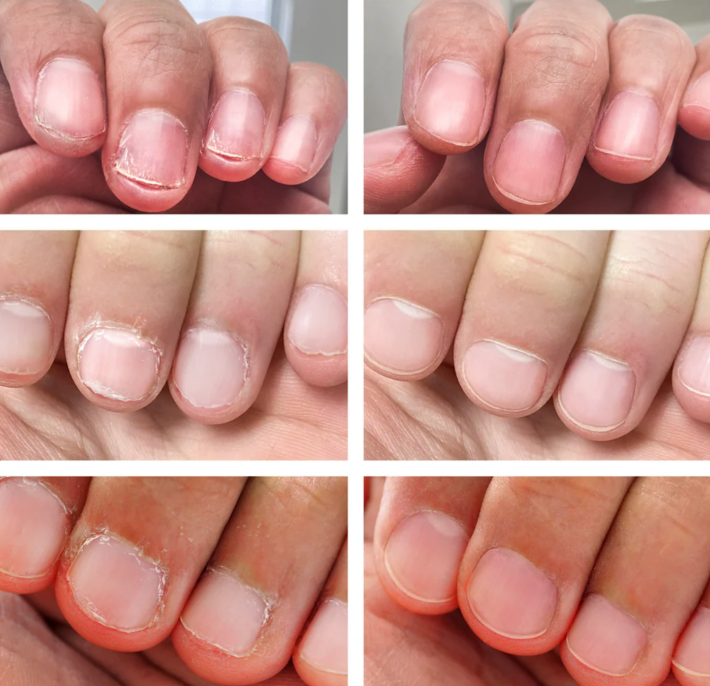 NAIL IT™ – Bitter-Taste Nail Biting Prevention Cream (For Men, Women & Children)