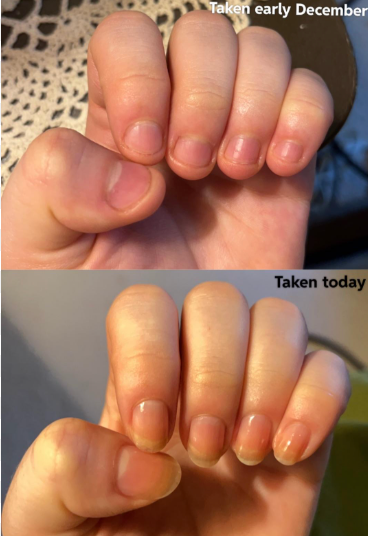 NAIL IT™ – Bitter-Taste Nail Biting Prevention Cream (For Men, Women & Children)